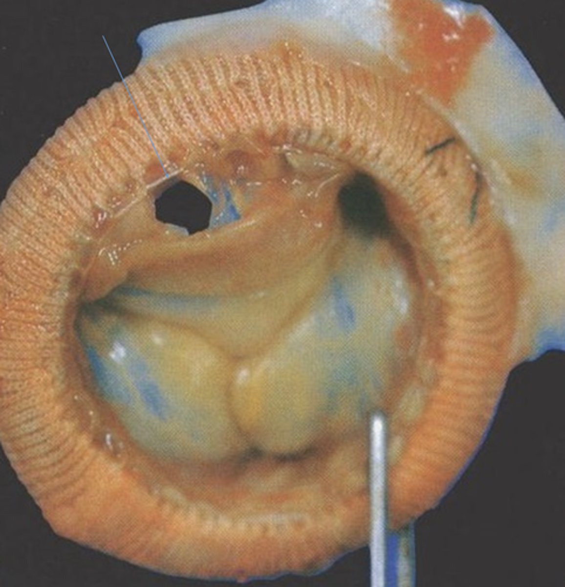<p>Damage to mechanics or breakdown of tissue within valve</p><p>Due to uneven stress or blood lipids</p><p>Causes valve regurgitation and malfunction</p>