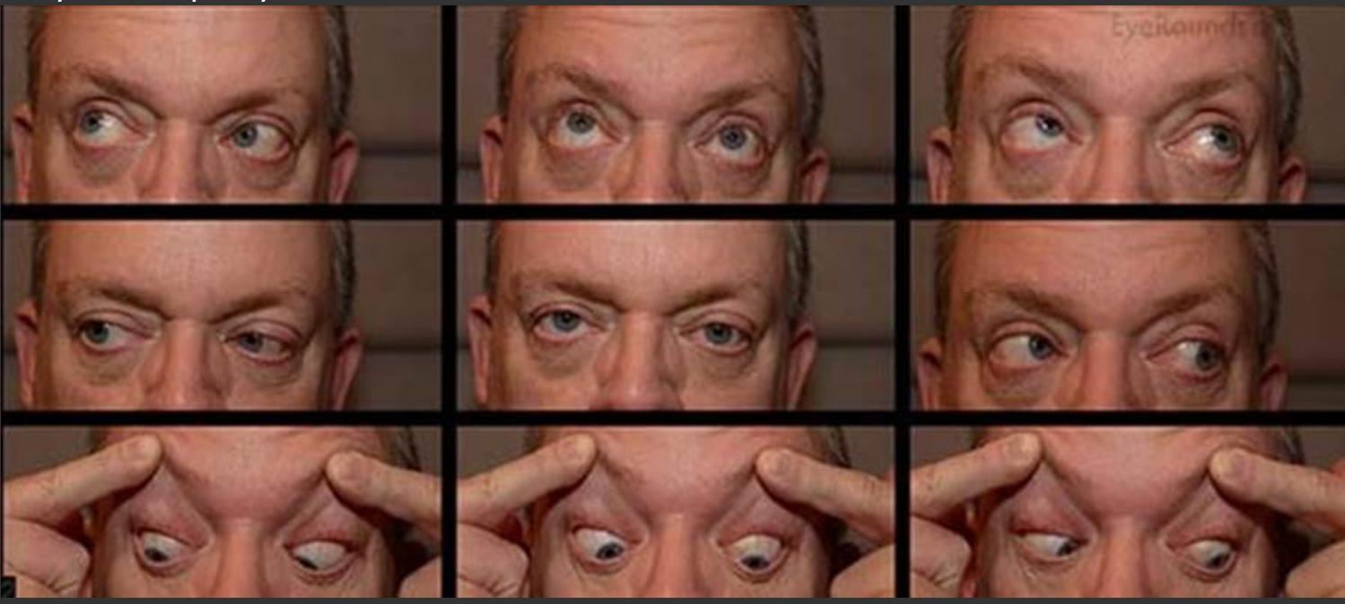 <p>A 50-year-old male presents to the office with the chief complaint of double vision after getting hit in the head with a bowling pin three days ago. Physical examination reveals the findings shown in the accompanying figure. Testing also reveals that the diplopia is worse with leftward gaze. He has normal strength and reflexes in all four extremities; pin prick sensation is normal on his face, trunk and limbs. A CT scan is negative. What muscle is most likely weak or paralyzed?</p>