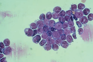 Figure 18: Lymphoblasts