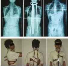 <p>Indications for Boston brace?</p>