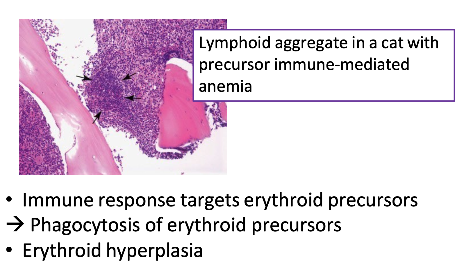 <ul><li><p>immune response targets erythroid precursors → <strong>phagocytosis of erythroid precursors</strong></p><ul><li><p>immature RBCs destroyed as they are produced</p></li></ul></li><li><p>erythroid hyperplasia</p></li></ul><p></p>