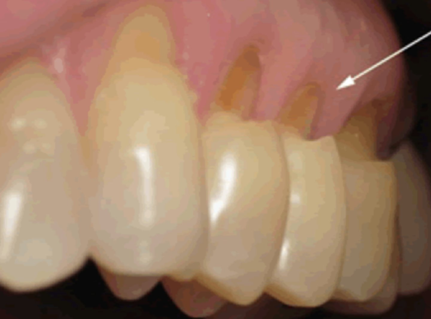 <p>Non-Carious Cervical Lesions (Cervical Loss of Tooth Structure)</p>
