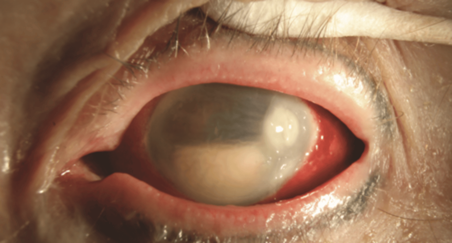 <p>What is the name of a condition that occurs from internal microbial ocular infection?</p>