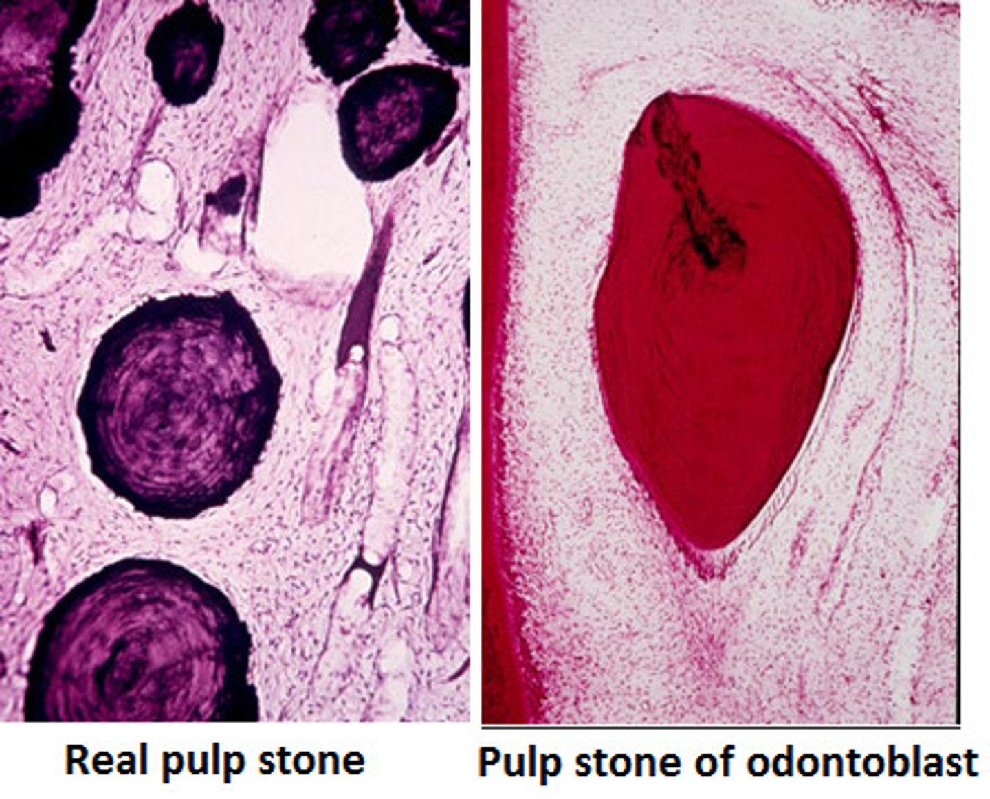 <p>Pulp stones that originate from odontoblasts.</p>