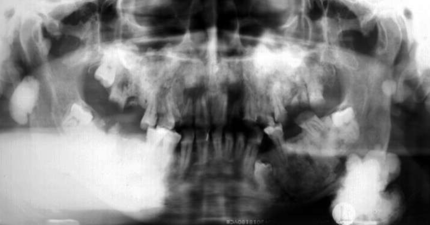 <p><strong>Gardner’s</strong> syndrome: multiple osteomas + unerupted supernumerary/permanent teeth </p>