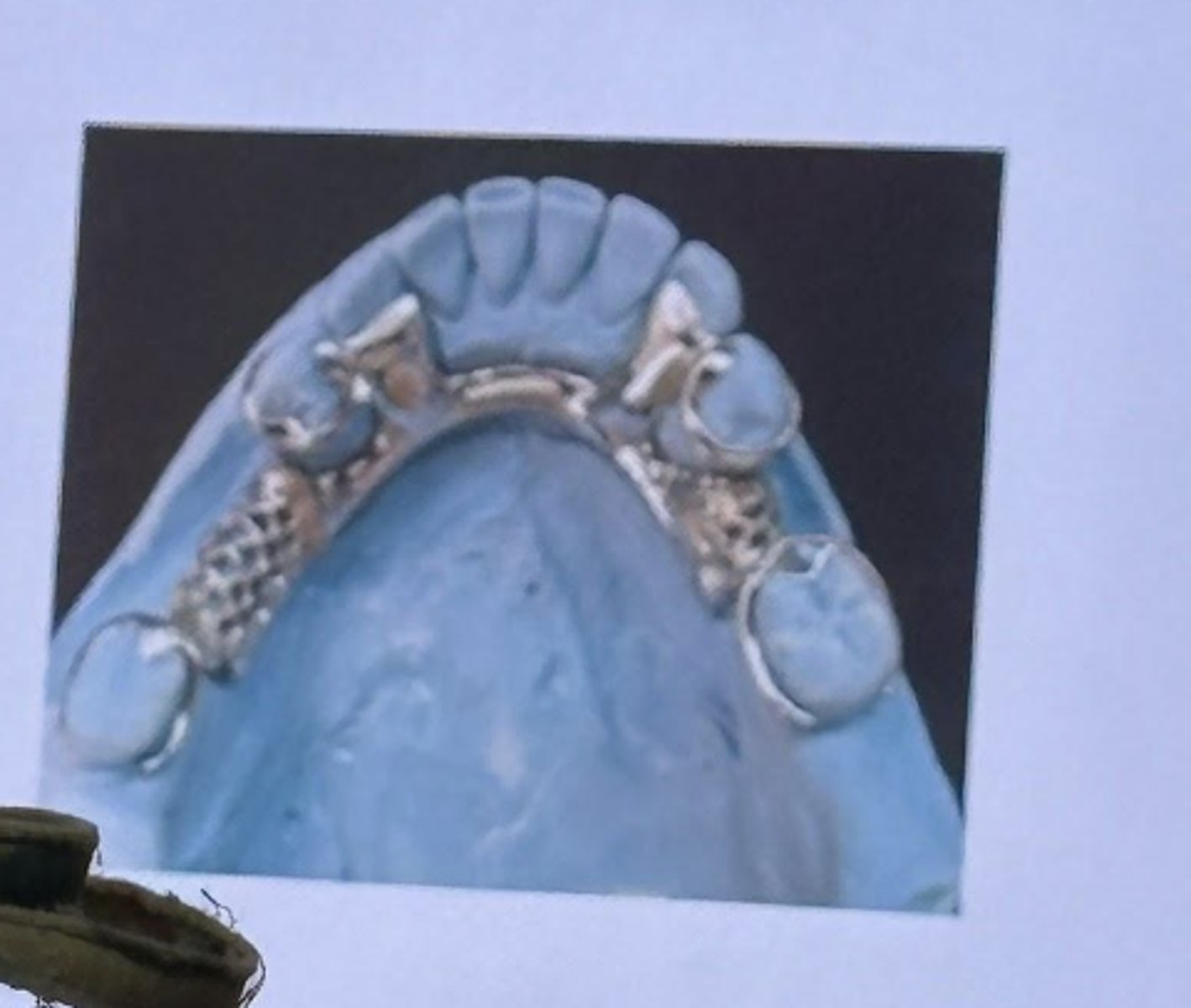 <p>-The operator achieved ideal balanced retention using four clasp assembles in the mesial-facial and distal facial undercuts of the molars and premolars</p><p>-four cast circumferential clasp retentive components are 0.01 undercuts</p><p>-the mandibular left determined the class</p>