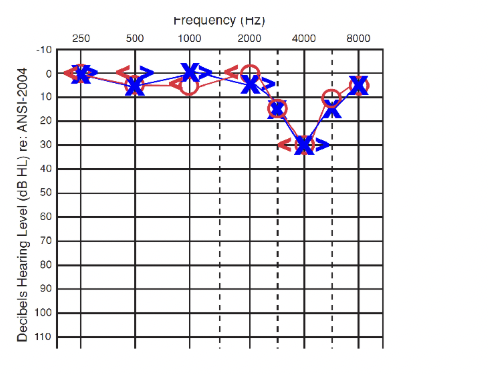 <p>Work in loud environment with no earplugs (musicians, military, factories, etc)</p><p>Notch at 3000, 4000, or 6000 Hz</p><p>Progressive high frequency hearing loss (sloping)</p>