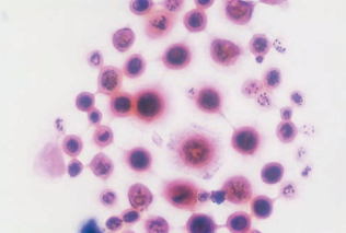 Figure 24: Gram stain of C. neoformans