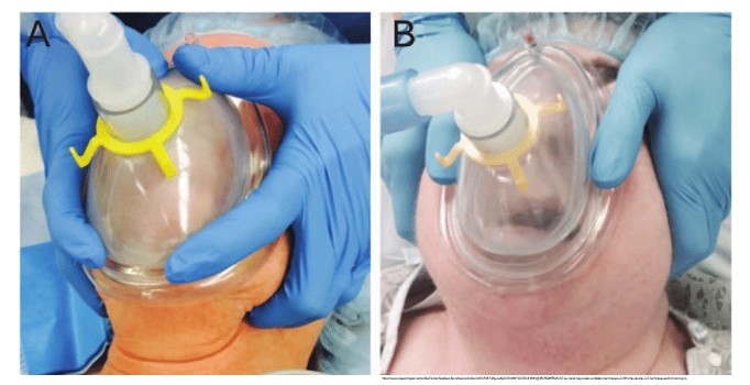   

•One practitioner holds the mask/face with both hands while a  second provider squeezes the bag

•Two techniques for holding the mask:

•Double C/E hold

  Thumbs/heels of hand on mask, 4 fingers pulling up on the mandible