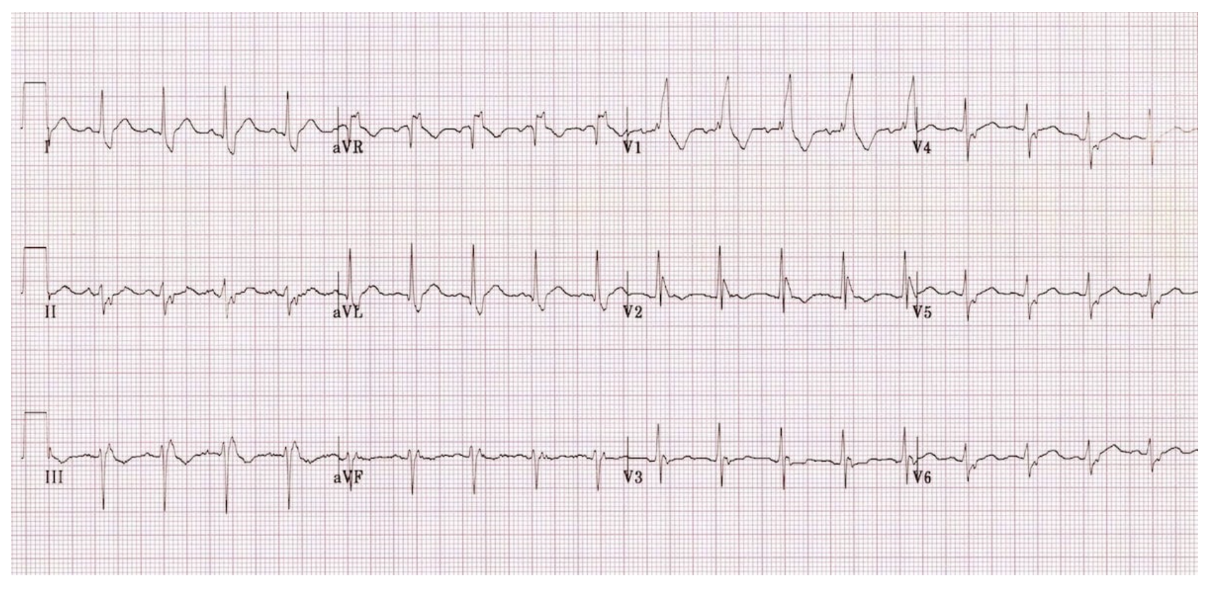 <p>Bifascicular block treatment</p>