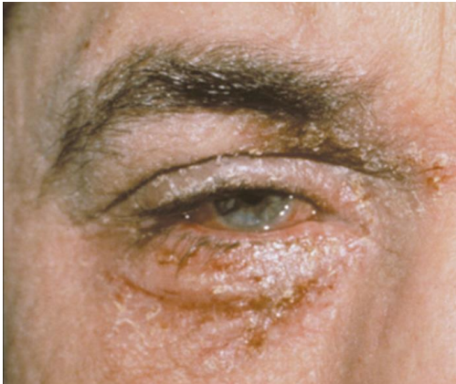 <p>Mucus/watery discharge, <strong><mark data-color="yellow" style="background-color: yellow; color: inherit"><u>scaly lids/dermatitis,</u></mark></strong> inf papillae, hyperemia</p>