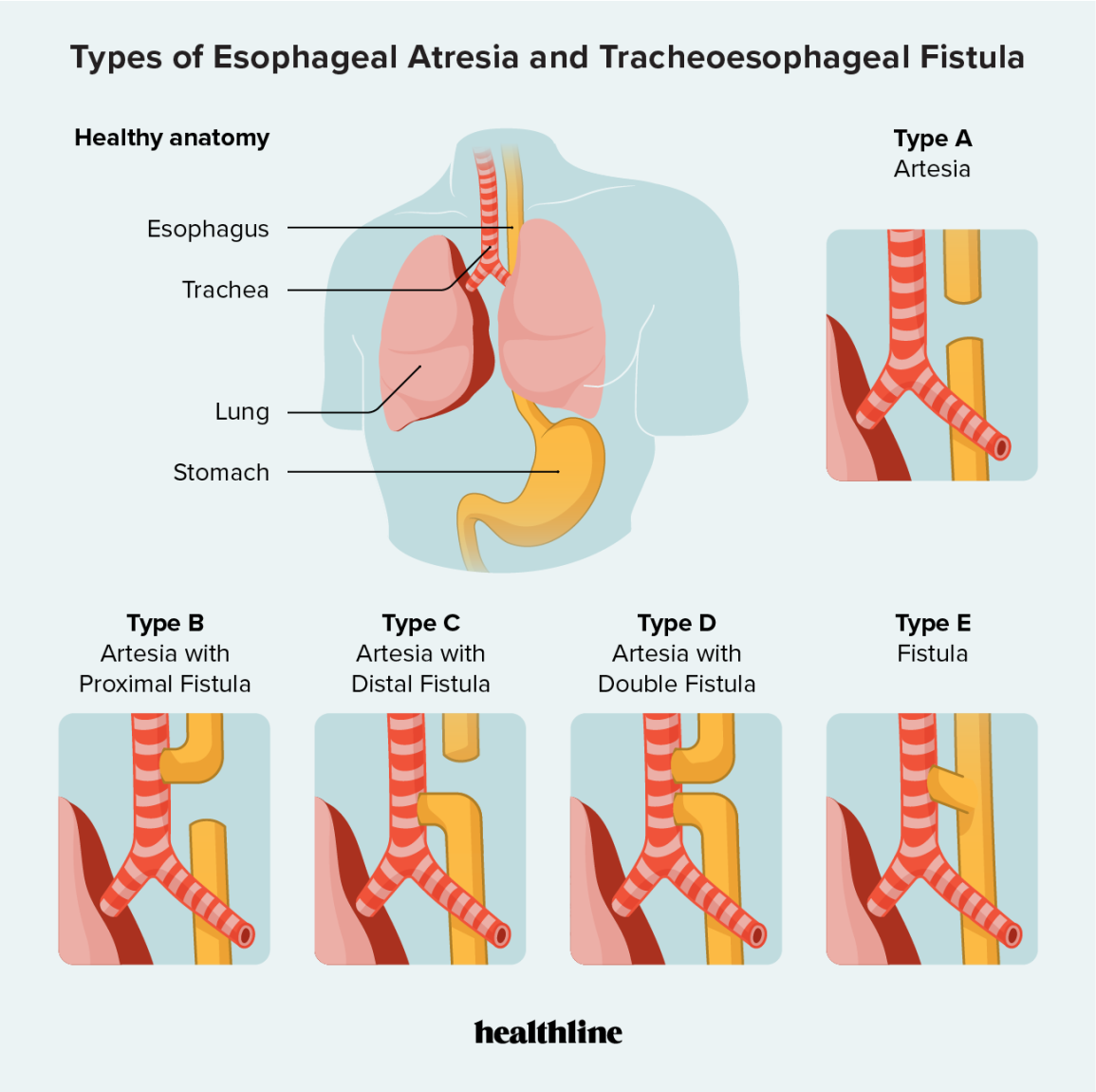 <p>an abnormal connection in at least one place between the esophagus (connects throat to stomach) and trachea (connects throat to windpipe and lungs). normally these two tubes are not connected </p>