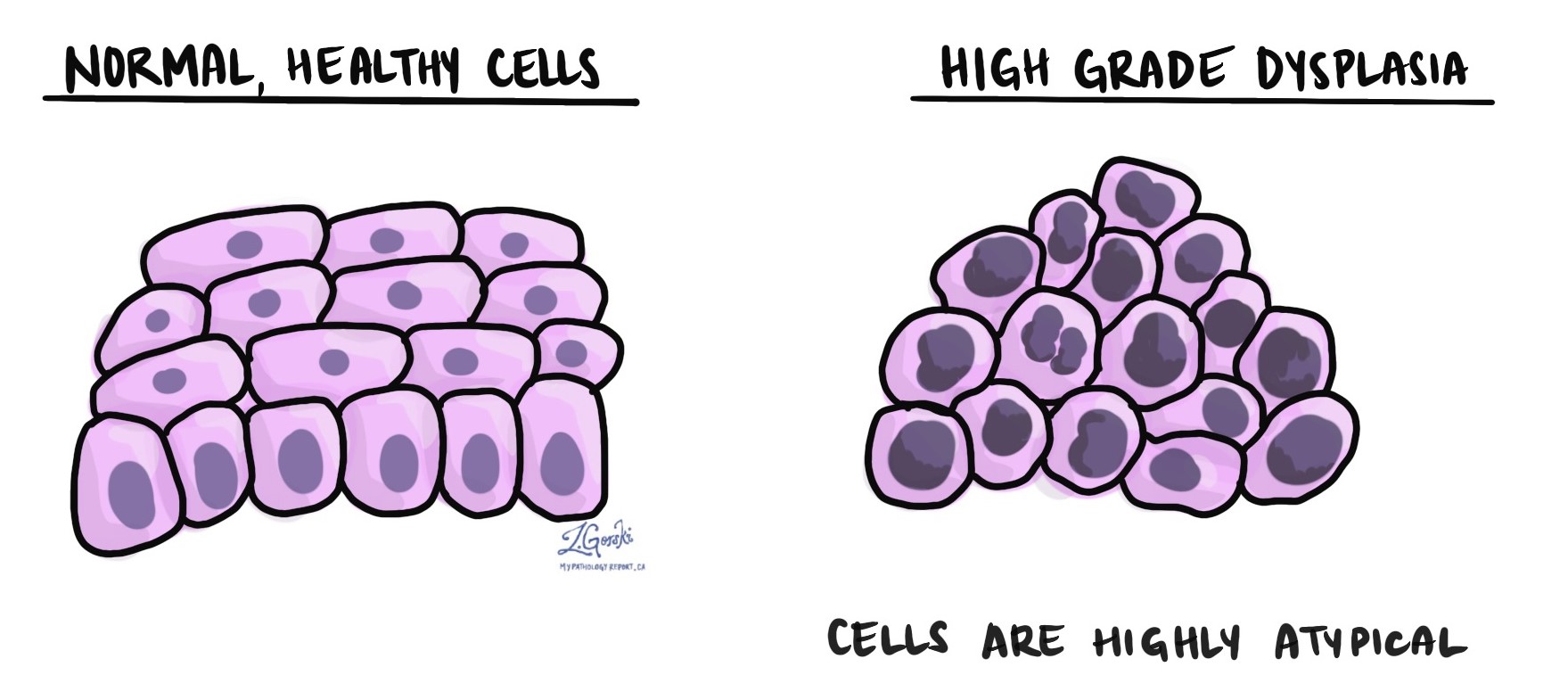 <p>Het basale membraan is nog niet aangetast. De cellen zijn heel onrustig en liggen niet meer netjes op een rijtje.</p>