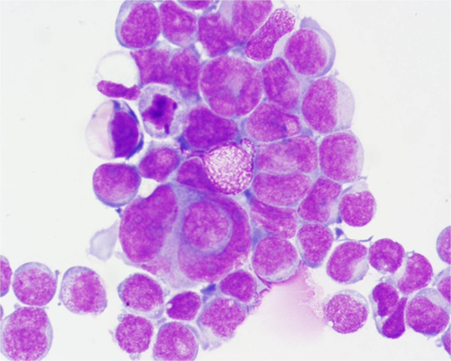 <p>A cerebrospinal fluid sample was taken from an inpatient with severe neurological symptoms. The image shows a field from a cytospin preparation from this patient's fluid. What findings are present in this field?</p>