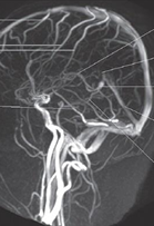 <p>Identify the superior sagittal, inferior sagittal and straight sinuses </p>