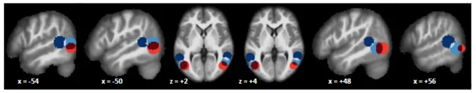 <p>Multivariate regression analysis in functional neuroimaging studies has revealed that the posterior superior temporal sulcus (pSTS), extrastriate body area (EBA), and middle temporal visual area (MT) are highly interconnected and collectively contribute to specialized visual processing, such as body and motion perception. </p><p>Specialized Roles in Perception:</p><ul><li><p>The pSTS is strongly associated with processing human actions and social cues, such as the direction a person is walking or their intentions, and maintains representations invariant to size or viewpoint changes.</p></li><li><p>The EBA primarily encodes the facing direction of a body (e.g., whether a person in a point-light display is facing towards or away from the viewer).</p></li><li><p>The MT (or MT+) is critically involved in general motion processing and encodes the direction of movement (e.g., walking direction in point-light displays).</p></li></ul><p></p>