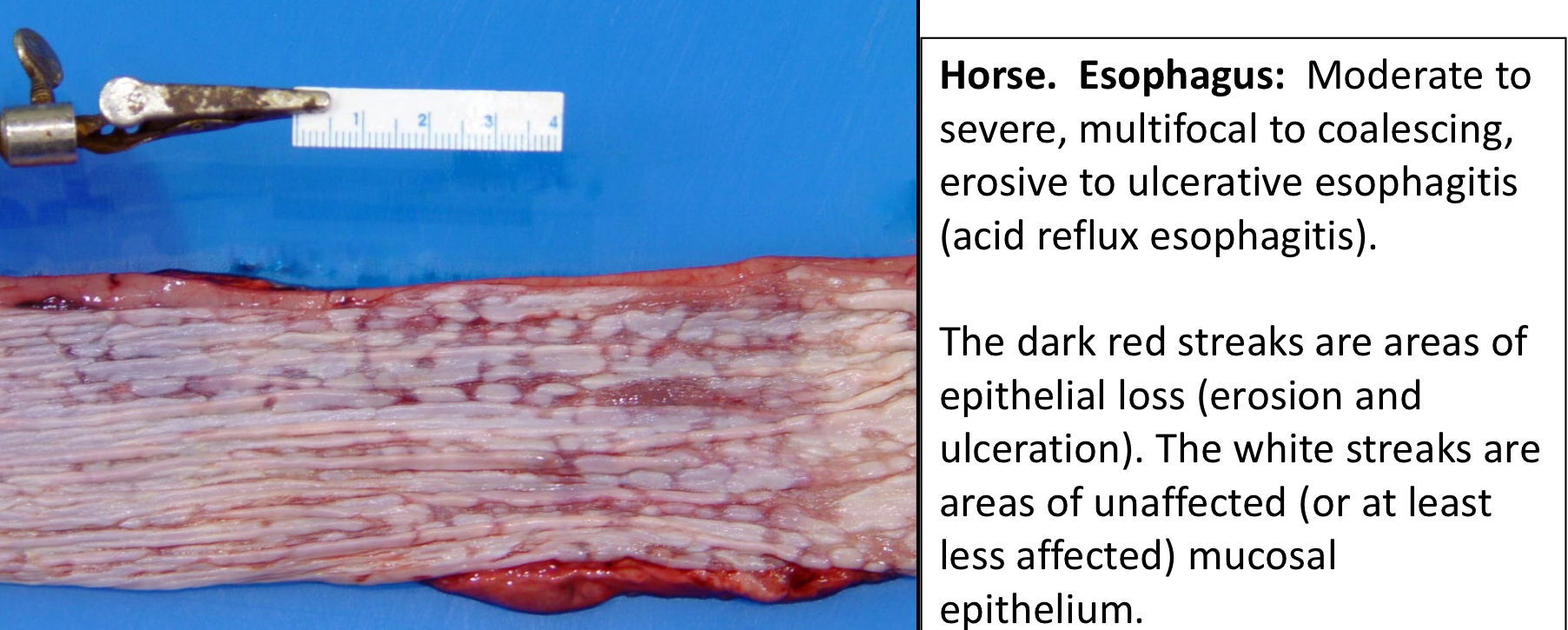 <p>Chemical damage of the epithelium in the esophagus due to r<strong><u>epeated gastric acid reflux</u></strong></p><p></p>