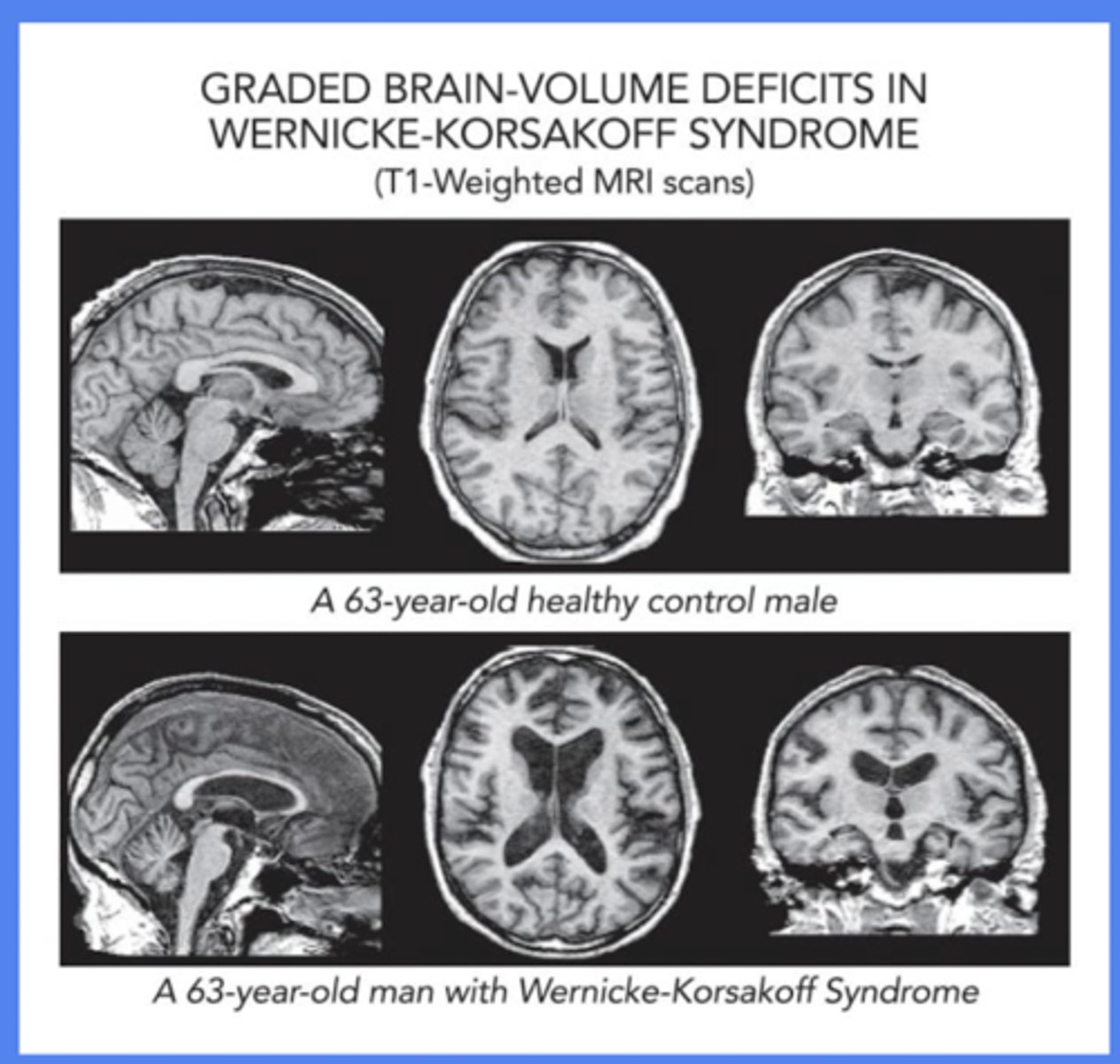 <p>- clinical presentation (triad + hx of risk factors, including malnutrition, alcohol use, bariatric surgery)</p><p>- imaging (MRI findings = lesions in mammillary bodies, periaqueductal area lesions, enlarged ventricles)</p><p>- laboratory tests (low thiamine, electrolytes abnormalities)</p>