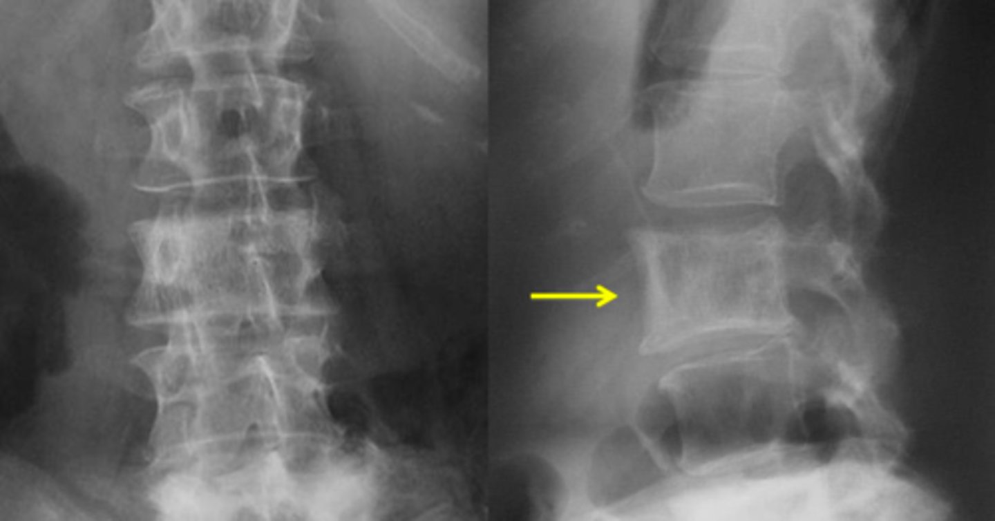 <p>Vignette # 27</p><p>Sex: Male</p><p>Age: 52</p><p>Chief Complaint: Patient presents with mid to low back pain. Pain is felt in every direction</p><p>Objective Findings: Kemps -, Yeoman’s + in hip ,thorarcolumbar junction and lumbar spine, coxa vara bilaterally</p><p>Diagnostic Imaging: X-ray</p><p>3. What’s the possible sequelae of this condition? (Choose 3)</p><p>a. Malignant degeneration</p><p>b. Spinal canal stenosis</p><p>c. Horner’s</p><p>d. Dyspnea</p><p>e. Tibial deformity (Saber shin)</p><p>f. Lymph node obstruction</p><p>g. Pathological collapse (bbt)</p><p>h. Lystic destruction</p>