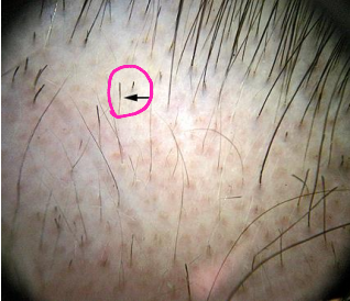 <p>On physical exam, a patient with alopecia areata would present with __________ ______ hairs, which is where a short hair breaks off with tapering down toward the proximal hair shaft</p>
