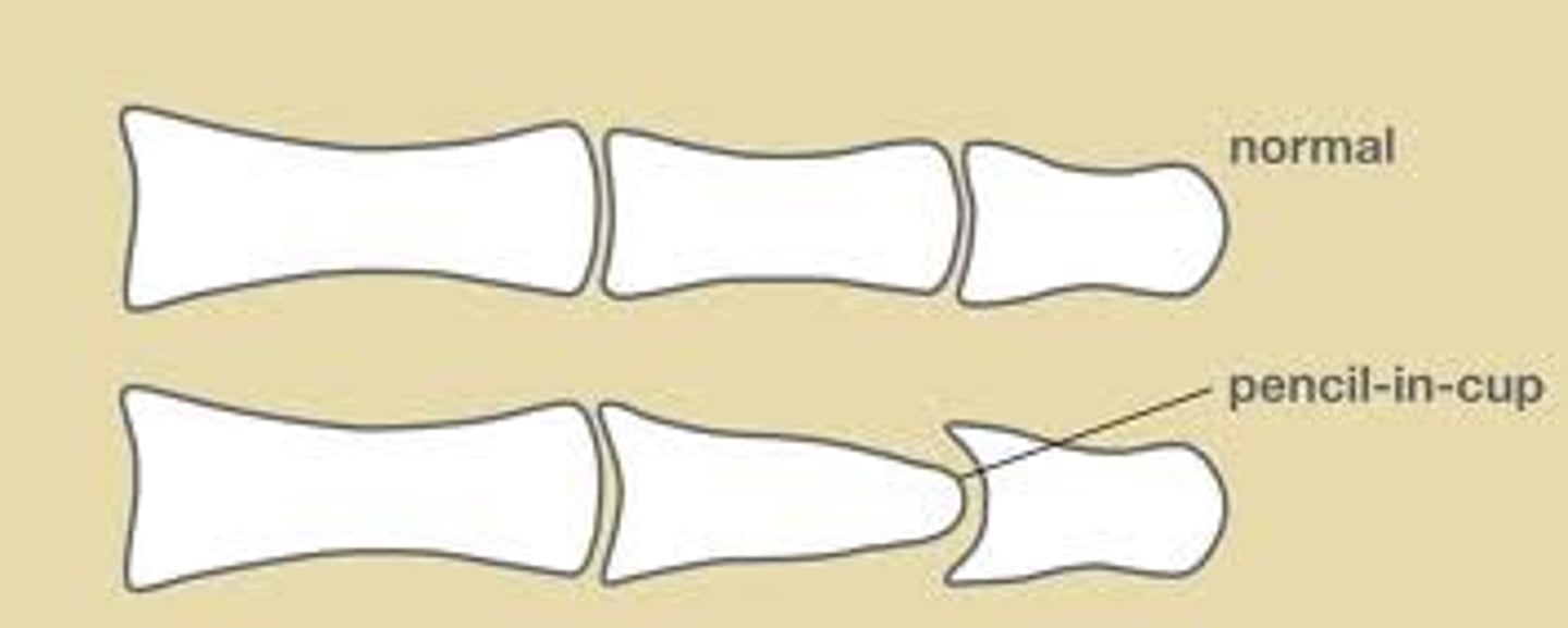 <p>psoriatic arthritis → resorption of terminal phalanges and proliferative bone reaction in DIP joints</p>