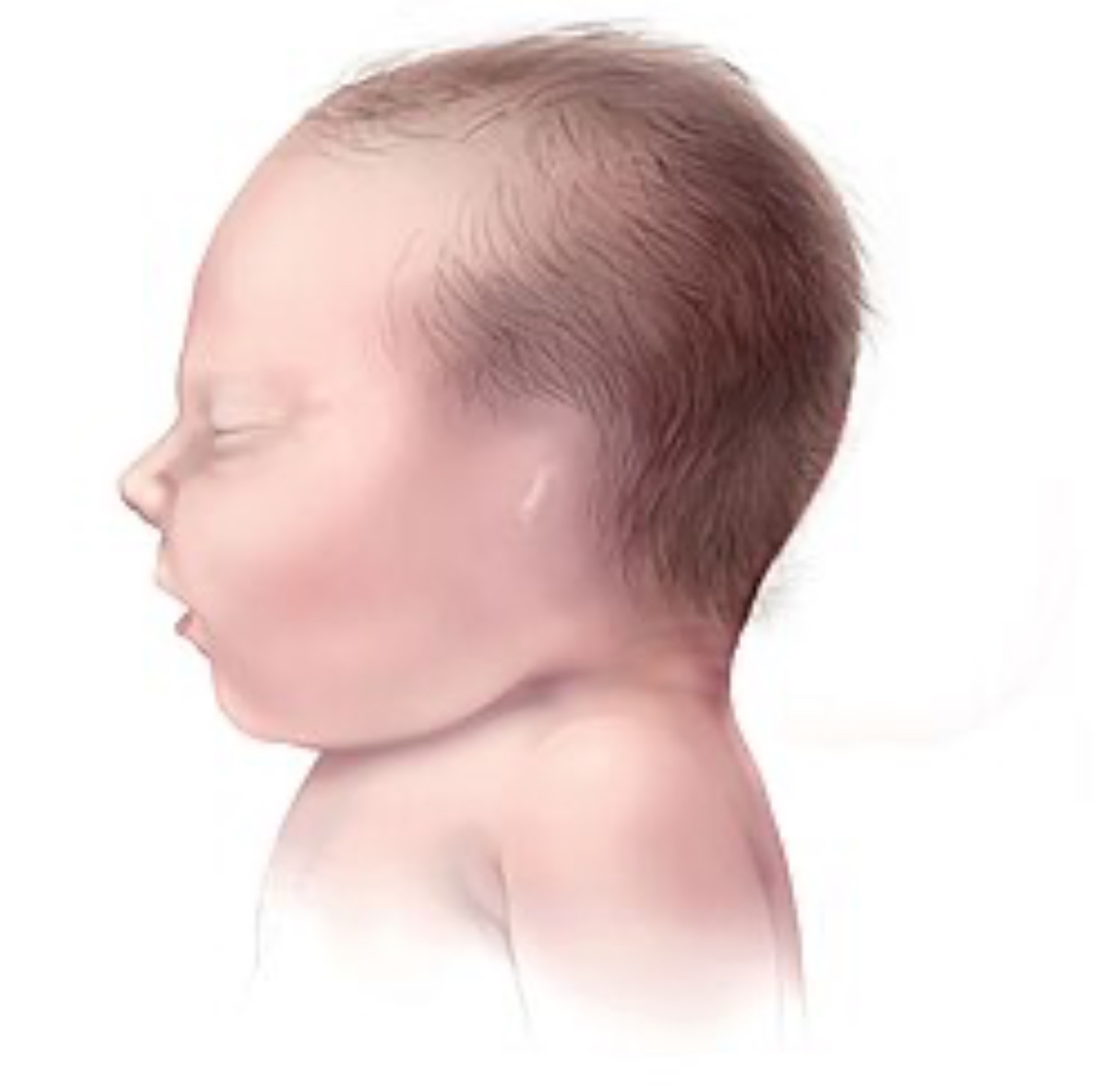 <p>Location: Pinna</p><ul><li><p>Absent pinna</p></li></ul><p></p>