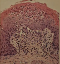 <p>Increased starch/sugar fermentation decreases pH</p><p>Gross:</p><ul><li><p>fermentative odour to rumen</p></li><li><p>ruminal epithelium adhered to submucousa</p></li><li><p>&lt;5pH</p></li><li><p>hyperaemic lamina propria</p></li></ul><p>Histo:</p><ul><li><p>cytoplasmic vacuolation of epithelial cells</p></li><li><p>Neutrophils in mucousa and submucousa</p></li></ul><p></p>