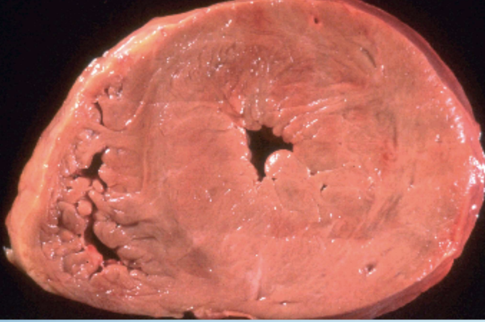 <p>Pathologic Hypertrophy</p>