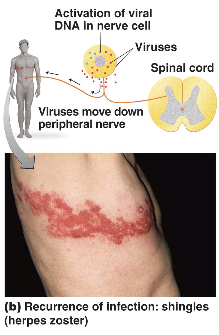 * A woman scratched through skin and skull to the brain
* Usually happens on one side of the body
* Reactivation of latent varicella-zoster virus releases virions that move along peripheral nerves to skin 
* Results in “postherpetic neuralgia” if prolonged 
* Prevention: Live attenuated zoster vaccine 
* Acyclovir may lessen symptoms 

\
