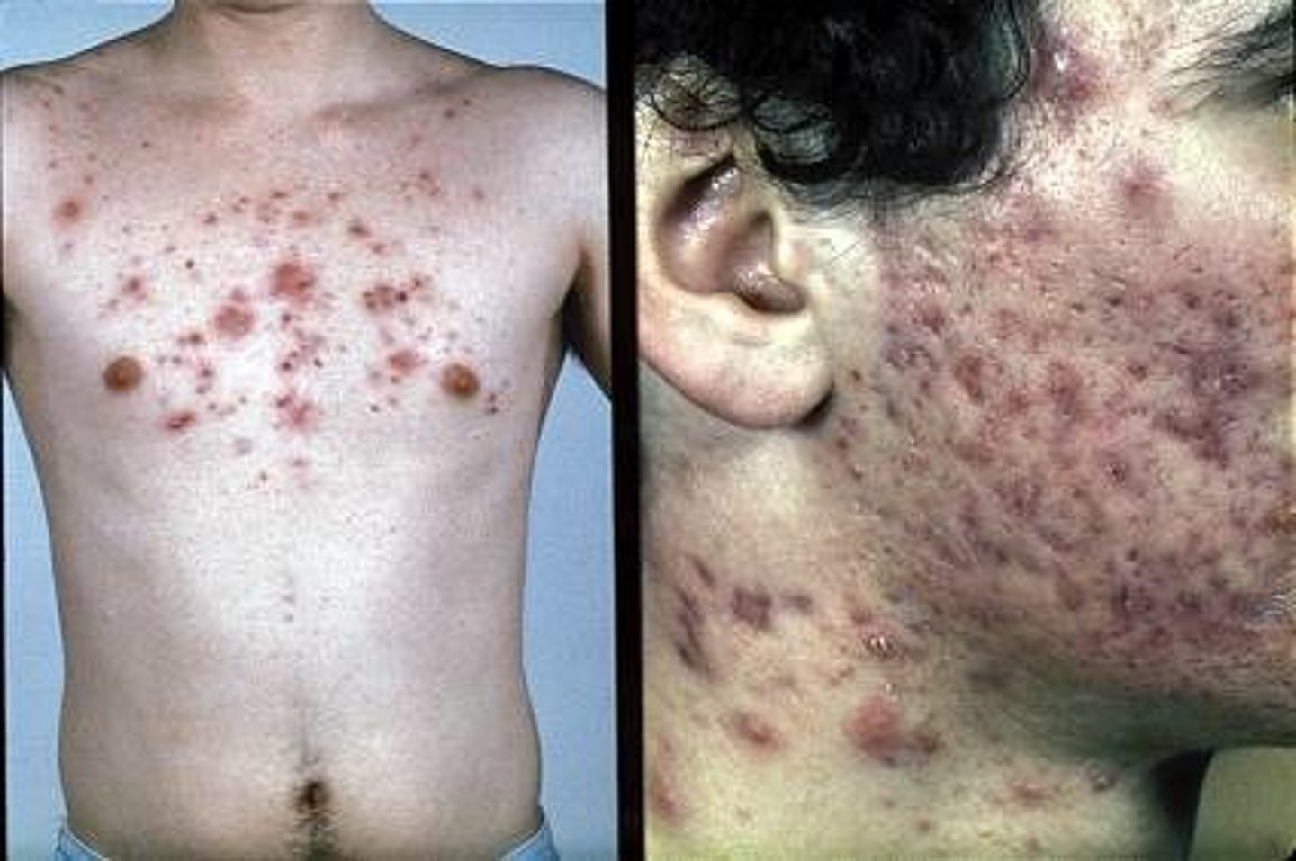 <p>Acne Vulgaris (Inflammatory)</p>