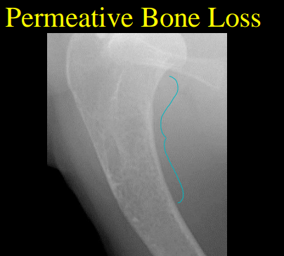 <ul><li><p><strong>Disuse osteoporosis </strong></p><ul><li><p><strong>50% loss</strong> before seen</p></li><li><p><strong>10d “no use”</strong></p></li></ul></li><li><p><strong>Geographic bone loss </strong></p><ul><li><p><strong>Focal lytic </strong>lesion in bone </p></li><li><p><strong>Center</strong> is <strong>necrotic/pus </strong></p></li><li><p>May be expansile </p></li></ul></li><li><p><strong>Punctate (permeative) lysis </strong></p><ul><li><p><strong>Multi</strong>, sm <strong>lysis </strong>regions</p><ul><li><p>can coalesce</p></li></ul></li><li><p><strong>Indistinct margins </strong></p></li><li><p><strong>Aggressive</strong> process</p></li></ul></li></ul><p></p>