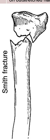 <p>Special</p><ul><li><p>Fracture of the wrist with a distal fragment of the radius displaced anteriorly</p></li><li><p>Results from backward fall on outstretched hand (FOSH)</p></li></ul><p></p>