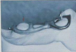 <p>a distal extension base must extend into the pterygomaxillary notch</p><p>this is to provide appropriate mechanical support for the denture base, the minor connector should extend beyond the most prominent portion of the tuberosity (arrow)</p>