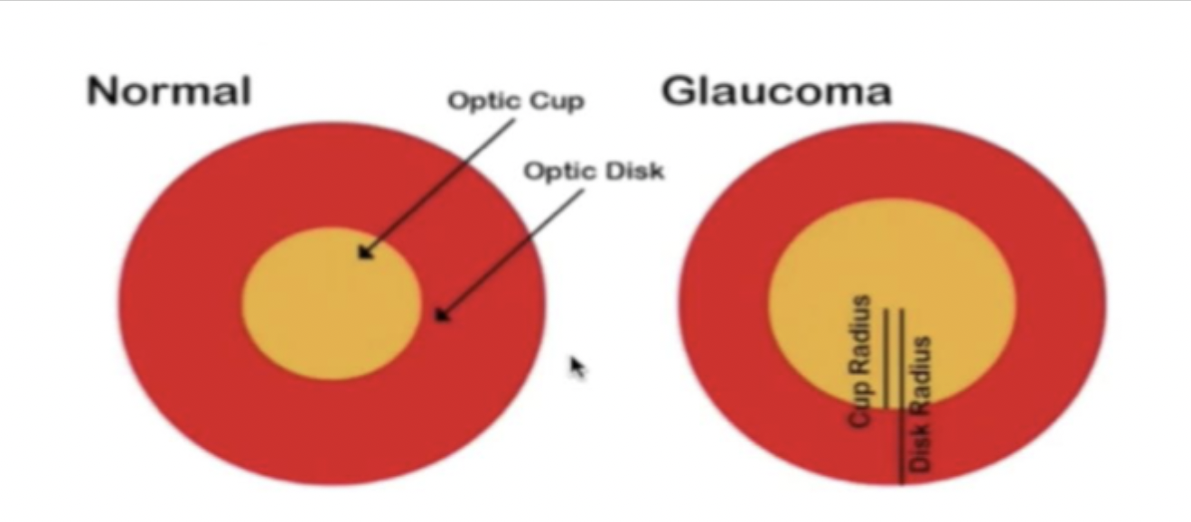 <p>What is the normal cup-to-disc ratio?</p>