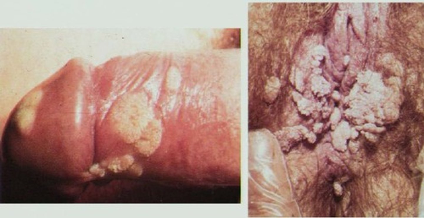 <p>Females = growths on the vulva, vaginal wall, cervix and perineum</p><p>Males = warts on the penis, foreskin, coronal sulcus, urethral meatus, penile shaft</p><p>Both sexes = warts in or on the anus, and the skin around the groin between the thigh and pelvis</p><p>Condyloma acuminata = branching, cauliflower-like masses</p><p>The warts can be asymptomatic or be accompanied with...</p><p>- Itching</p><p>- Burning</p><p>- Discomfort</p>