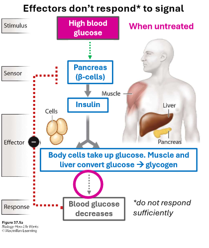 <p>caused by insulin resistance in target cells (insulin stimulation does not cause sufficient glucose uptake). the feedback loop exist but it is weak, hence effectors does not respond to signal</p>