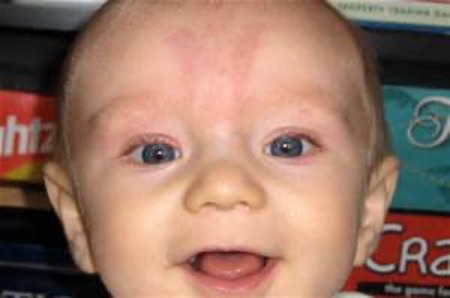 <p><strong>What skin condition?</strong></p><ul><li><p>Flat irregular light pink patches</p></li><li><p>often disappears by age 1</p></li><li><p>“stork bite” → nape of neck</p></li><li><p>“angel kisses” → upper lip, upper eyelids, forehead</p></li><li><p>also: “salmon patch”, telangiectatic nevus, capillary hemangioma</p></li></ul><p></p>