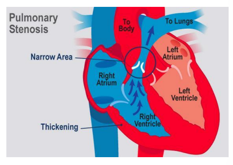 <ol><li><p>excessive pressure in the pulmonary arteries</p></li><li><p>this can result in right-sided heart failure</p></li><li><p>results in fluid backing up into the legs, veins in the neck, liver, and so on. </p></li></ol><p></p>