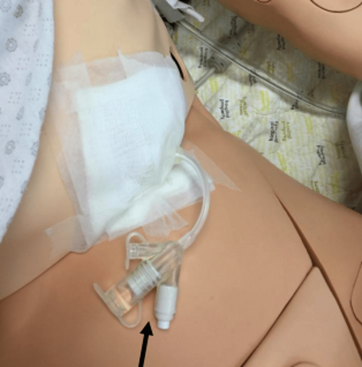 <p>- feeding tube surgically inserted into middle of pt.'s stomach</p><p>- pt. is not allowed to have any food by mouth</p><p>- can administer medications and liquid food through it</p><p>- place gait belt above tube</p><p>- pt. cannot be in supine, needs to be at least 35-40 degrees elevated</p><p>- long term</p>