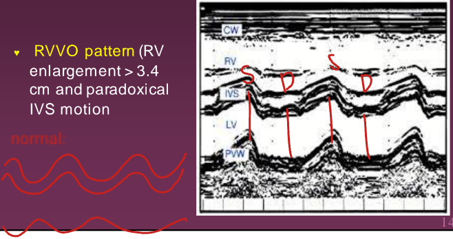 <p>The RVVO pattern. This shows the RV is dilated (> 3.4 cm) and has paradoxical IVS motion (abnormal).</p>