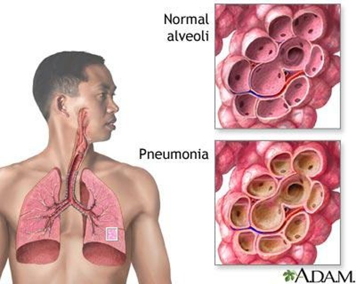 <p>-inflammation of the lungs and produces EXCESS fluid and causes an infection</p><p>-damage to the bronchial mucous membranes and alveolocapillary membranes</p><p>-infectious debris and exudate</p><p>-some microbes will release toxins from cell walls which will further lung damage</p><p>-top ten leading causes of death in the US</p>