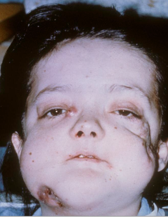 <ul><li><p>Frontal bossing</p></li><li><p>Hypertelorism</p></li><li><p>Broad face</p></li><li><p>Snub nose</p></li></ul><p></p>