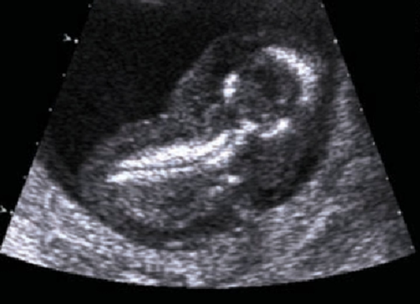 <p>Anasarca</p>