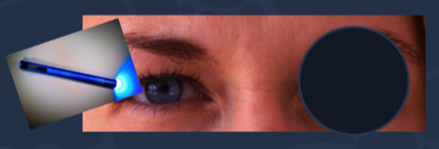 <p>pt occludes light sensitive, painful eye and shine light in normal eye = if consensual response is intact, the bad eye pupil will constrict and will increase the pain</p>