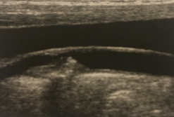 <p>What kind of plaque is seen here?</p>