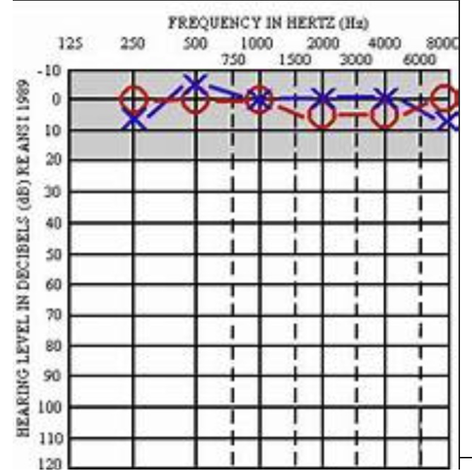 <p>What does this audiogram show?</p>