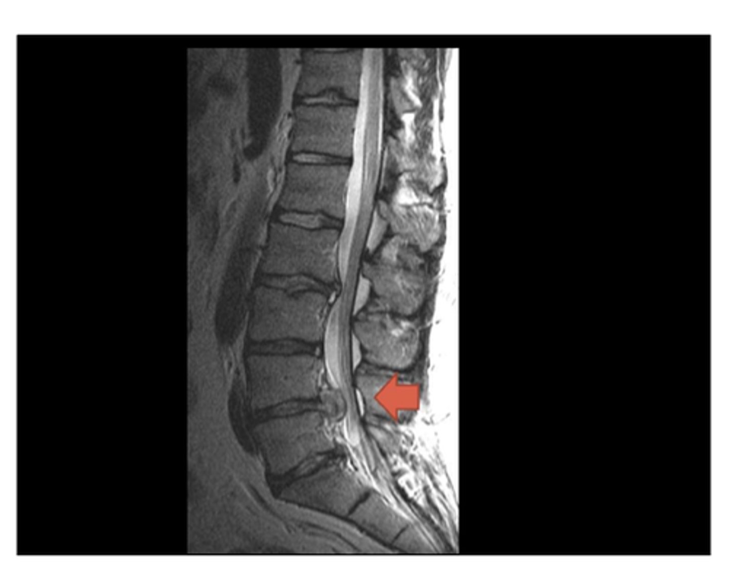 <p>extrusion of the nucleus pulposus through the annulus fibrosus of an intervertebral disc</p>