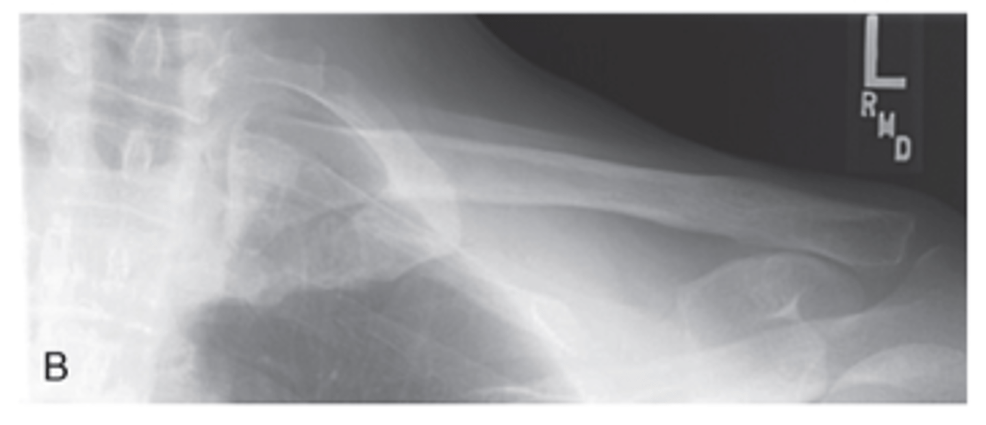 <p>- CR 15° to 30° perpendicular to midclavicle</p><p>- Entire clavicle demonstrated</p><p>- Four-sided collimation</p><p>- Optimal exposure factors</p><p>- More of clavicle seen above ribs</p>