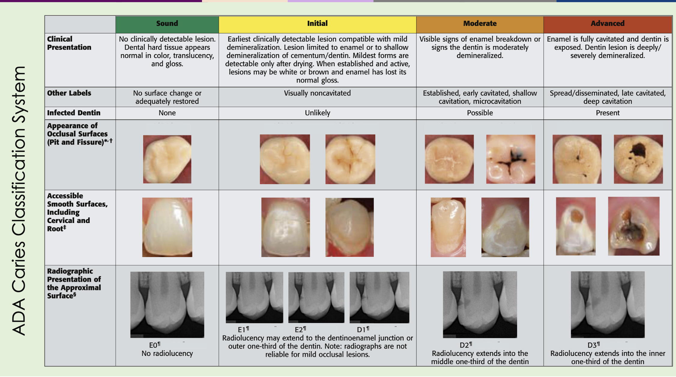 <p><span style="background-color: transparent;"><span>E1, E2, D1</span></span><br><br><span style="background-color: transparent;"><span>Notes:<br>Advanced Lesion through the Dentin<br>Moderate Lesion through D2</span></span></p>
