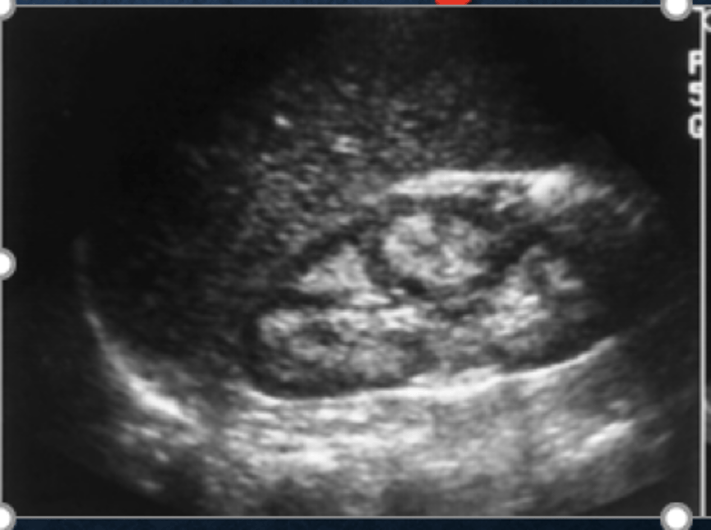 <p>-normal or small kidneys</p><p>-echogenic parenchyma</p><p>-small cysts in medulla</p><p>-hyperechoic calyces w/wo shadowing</p>